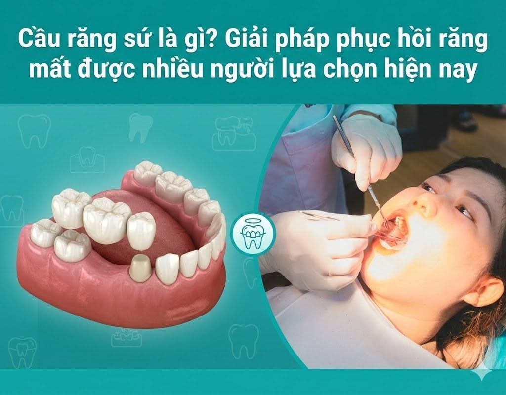 Cầu răng sứ là gì? Giải pháp phục hồi răng mất được nhiều người lựa chọn hiện nay