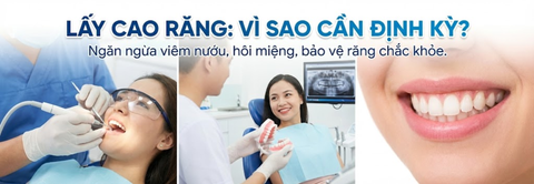 Lấy cao răng là gì? Vì sao nha sĩ khuyên nên lấy cao răng định kỳ?