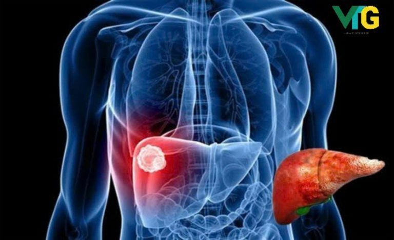 Ung thư gan không phải là kết thúc, mà là một khởi đầu mới với sự chăm sóc toàn cầu