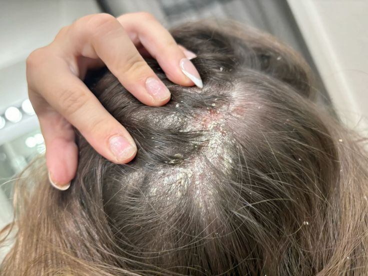 Da đầu bít tắc do dầu, mồ hôi và sản phẩm tạo kiểu: xử lý thế nào?