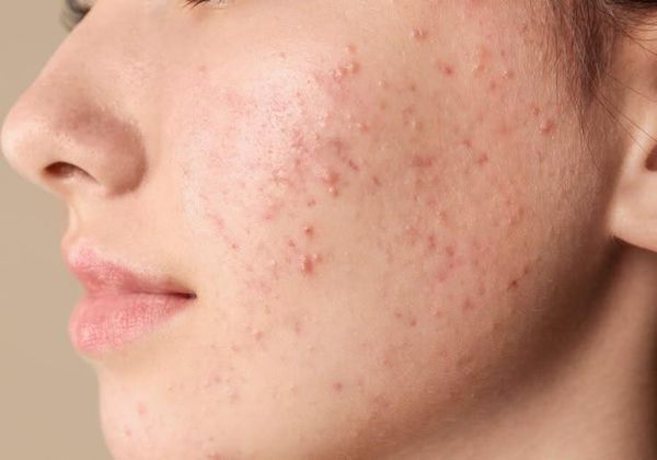 Tinh dầu tràm trà cho da đầu: dùng sao để ít kích ứng?