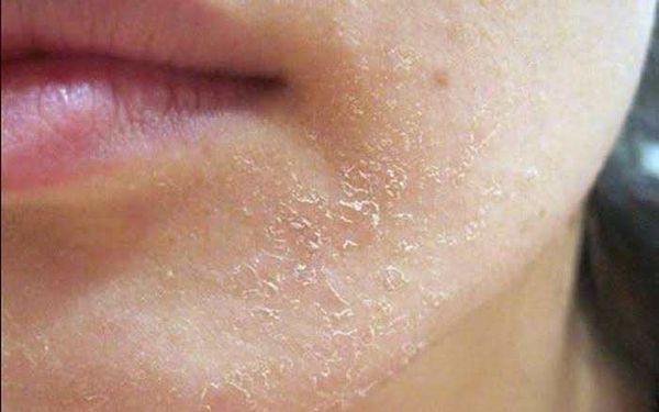 Phân biệt da khô và da thiếu ẩm: Dấu hiệu nào giúp nhận biết đúng?
