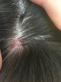 Nên chọn gội dưỡng sinh hay Scalp Detox khi có vảy da đầu?