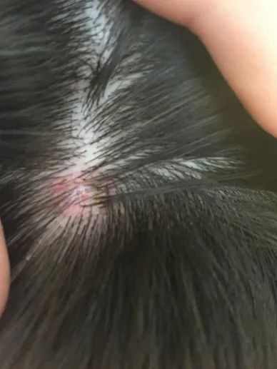 Nên chọn gội dưỡng sinh hay Scalp Detox khi có vảy da đầu?