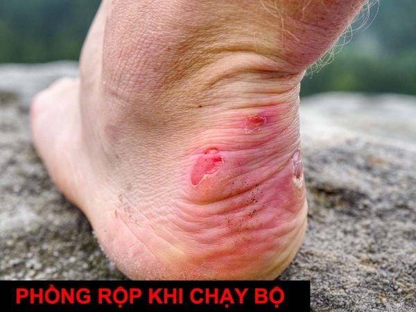 Phồng rộp khi chạy bộ: Nguyên nhân, cách ngăn ngừa và giải pháp hiệu quả