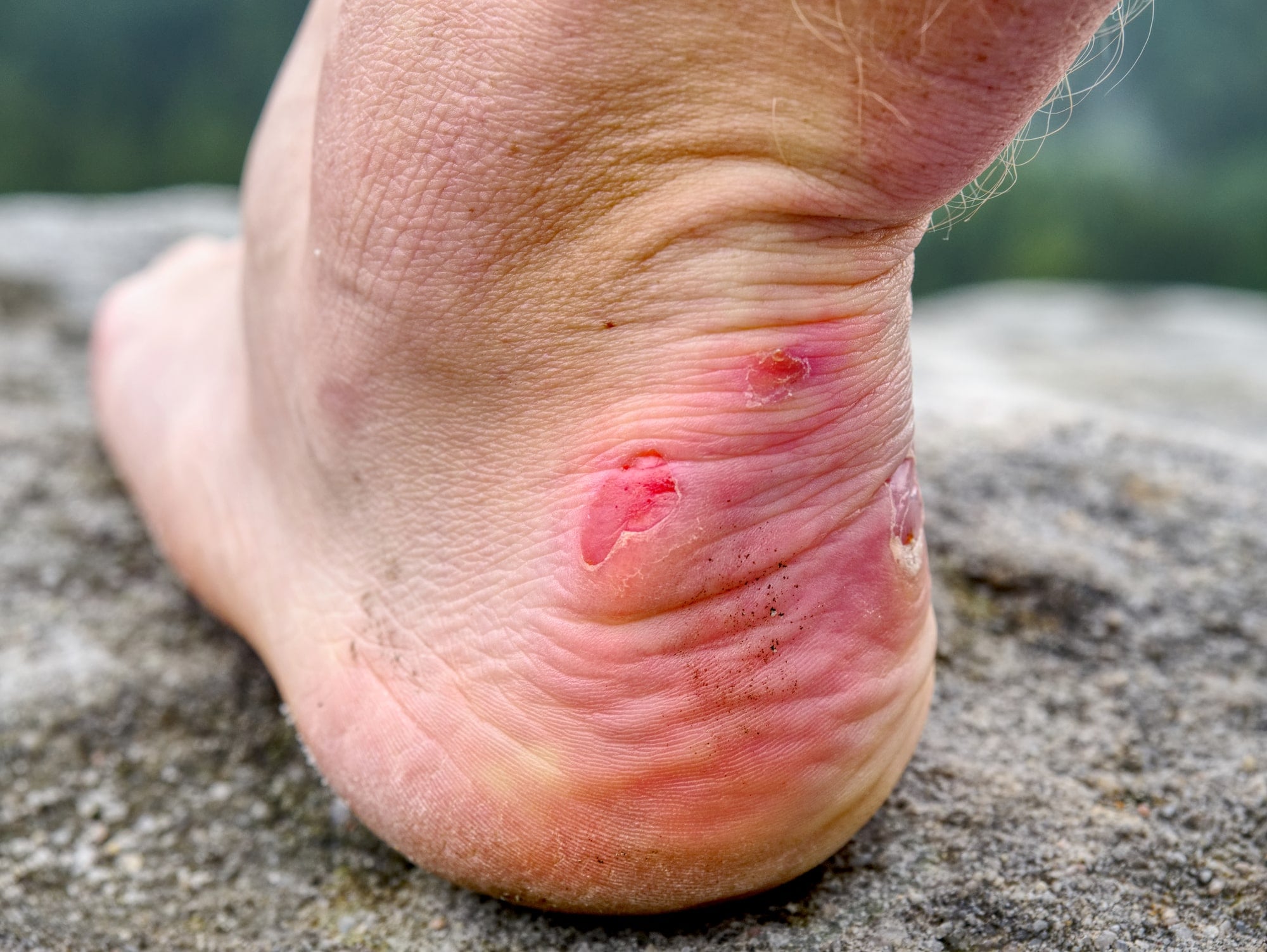 Diabetic Blisters | Care and Treatment | Podiatrist Near Corona