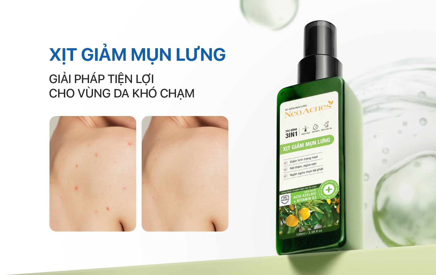 Xịt giảm mụn lưng: Giải pháp tiện lợi cho làn da sạch mụn và tự tin hơn