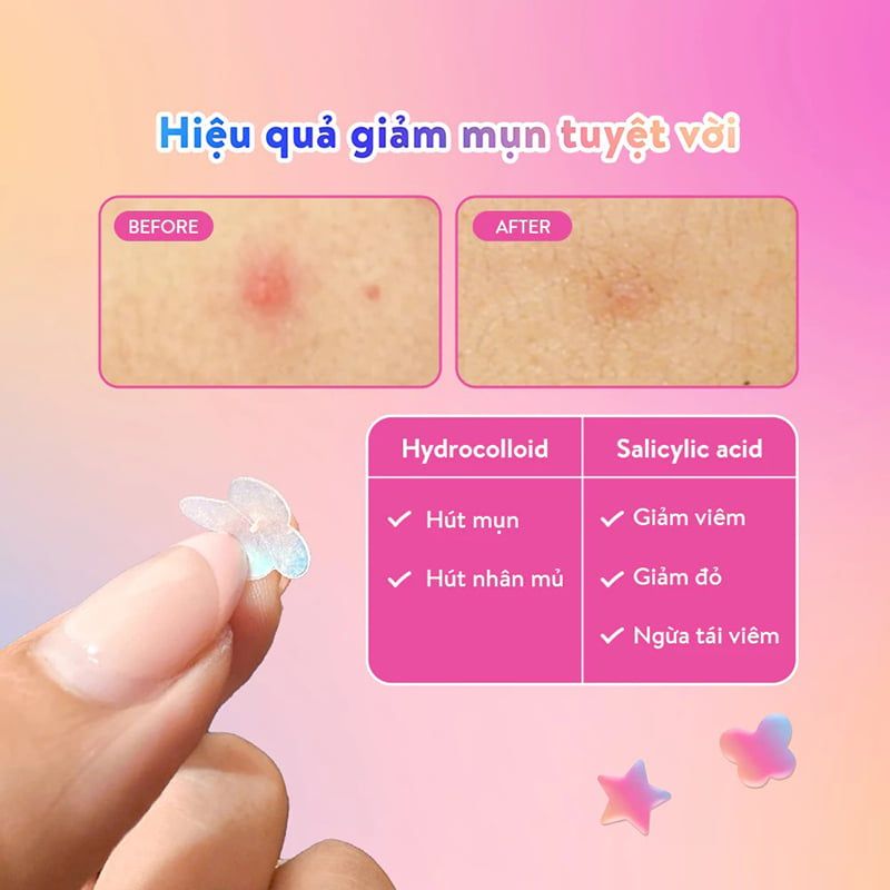 Miếng Dán Mụn Derma Angel Hình Vui Nhộn Acne Beauty Patch Colorful Mix Shaped (12 miếng)