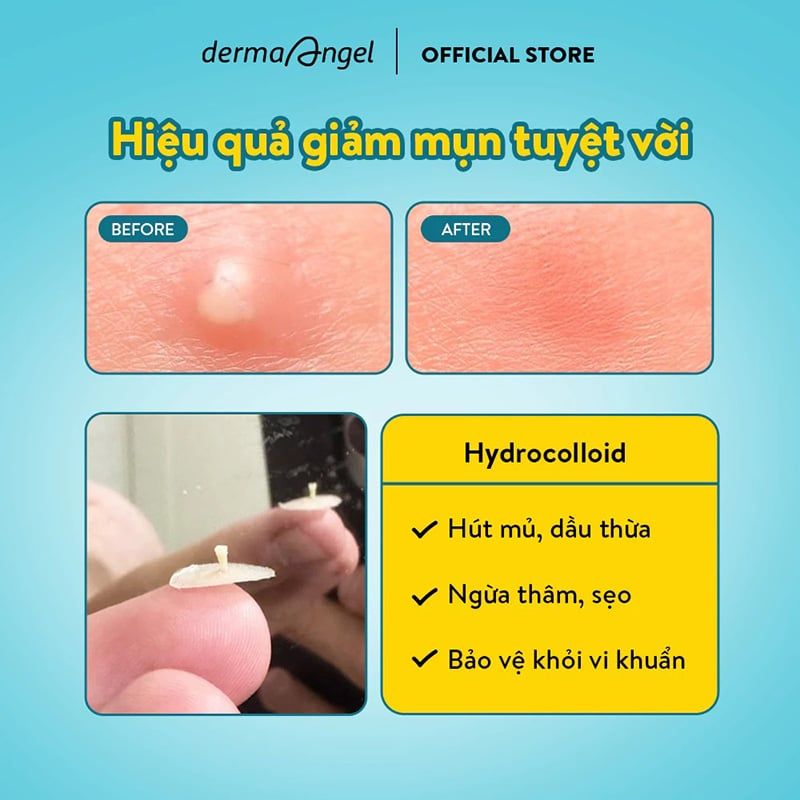 Miếng Dán Mụn Dùng Cho Ngày Và Đêm Derma Angel Acne Patch Original