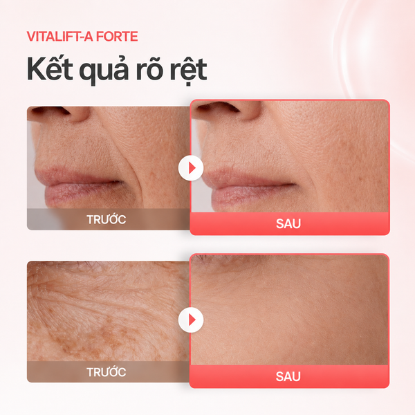 Kem dưỡng trẻ hoá, mờ nhăn Dr.Different Vitalift-A Forte Retinal 0.1% Night Treatment Cream