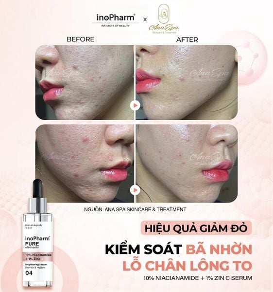 Tinh chất dưỡng ẩm, giảm mụn & sáng da InoPharm Pure Elements Facial Serum with 10% Niacinamide + 1% Zinc