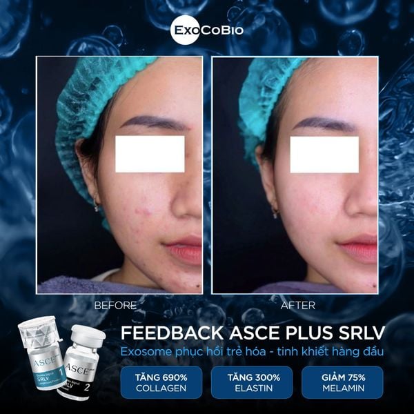 Bộ phục hồi da, căng bóng da ExoCoBio Asce+ SRLV Derma Signal