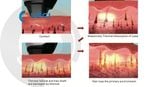  Máy triệt lông laser LAMIS-L 