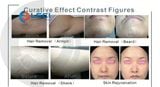  Máy triệt lông laser LAMIS-L 