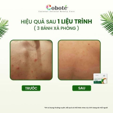 Xà Phòng Ngừa Mụn Cơ Thể 120g - Phiên Bản Tối Giản Bao Bì Tiết Kiệm