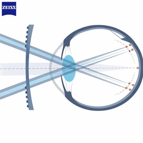  Zeiss MyoCare – Tròng Kính Trẻ Em Kiểm Soát Cận Thị Thế Hệ Mới 