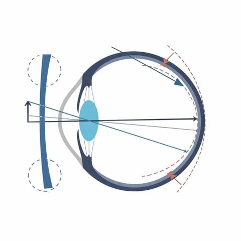  Zeiss MyoVision Pro – Tròng Kính Kiểm Soát Cận Thị Trẻ Em Thế Hệ Mới 