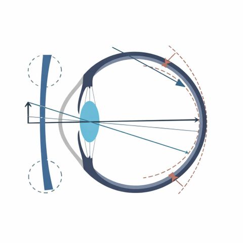  Zeiss MyoVision Pro PhotoFusion X – Tròng Kính Đổi Màu Trẻ Em Tích Hợp BlueGuard 