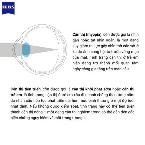  Zeiss MyoVision Pro PhotoFusion X – Tròng Kính Đổi Màu Trẻ Em Tích Hợp BlueGuard 