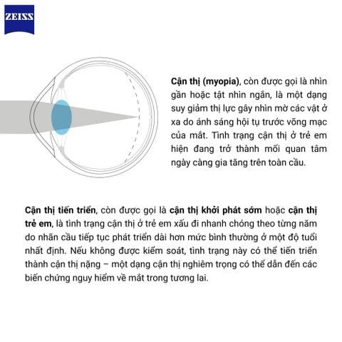  Zeiss MyoVision Pro – Tròng Kính Kiểm Soát Cận Thị Trẻ Em Thế Hệ Mới 