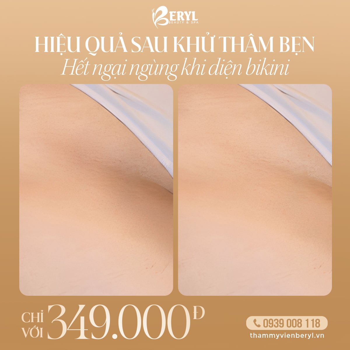 Trị Thâm Bẹn 349k