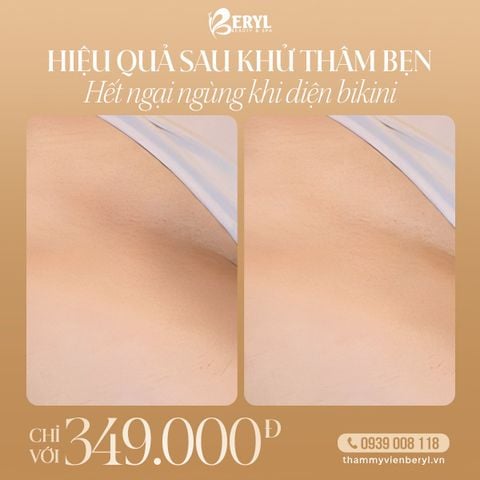 Trị Thâm Bẹn 349k