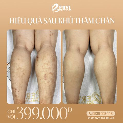 Trị Thâm Chân 399k
