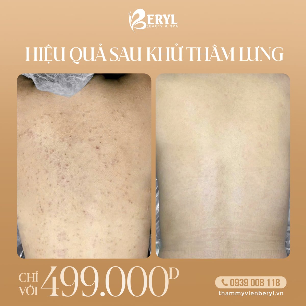 Trị Thâm Mụn Lưng 499k