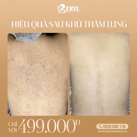 Trị Thâm Mụn Lưng 499k