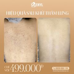 Trị Thâm Mụn Lưng 499k