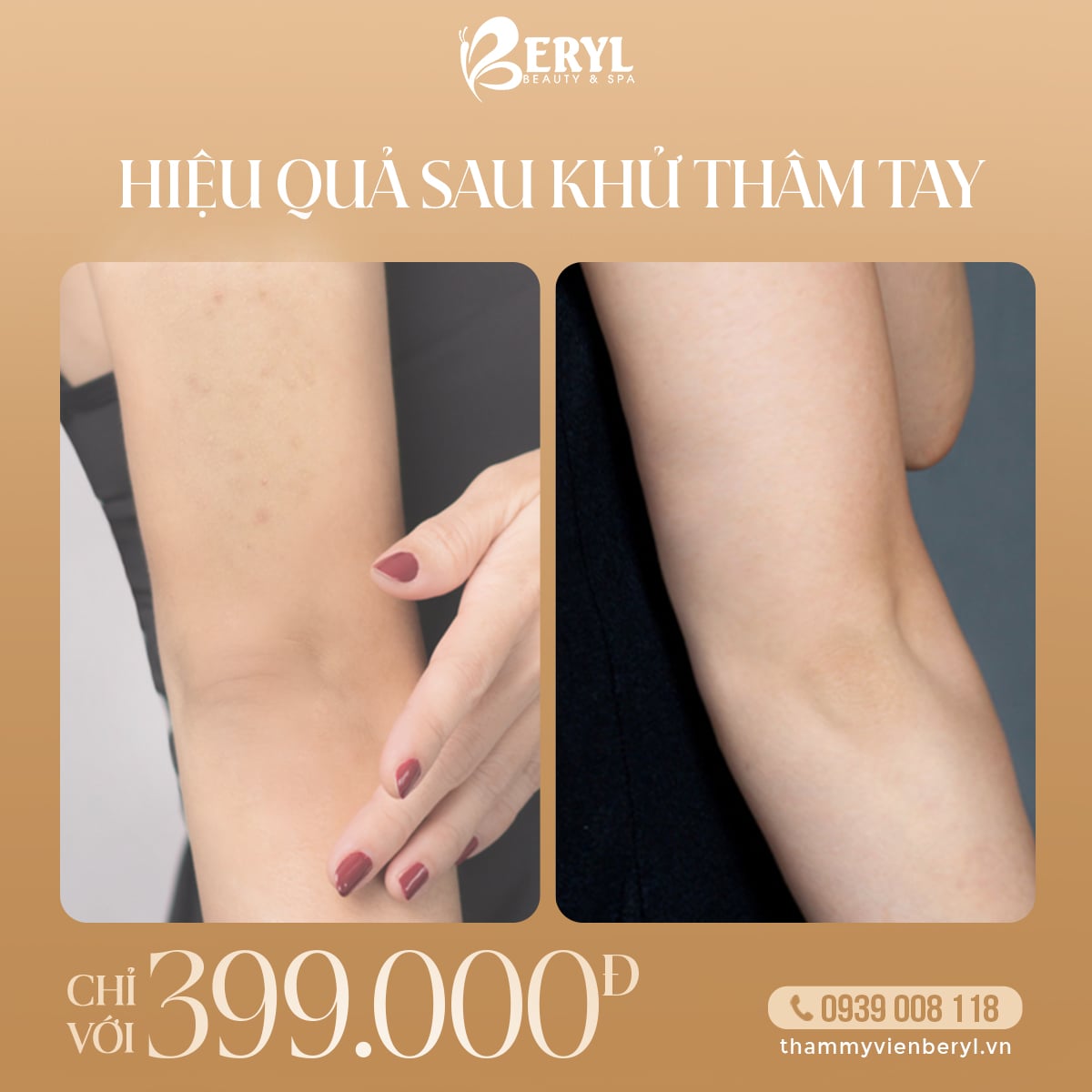 Trị Thâm Khuỷu Tay 399k