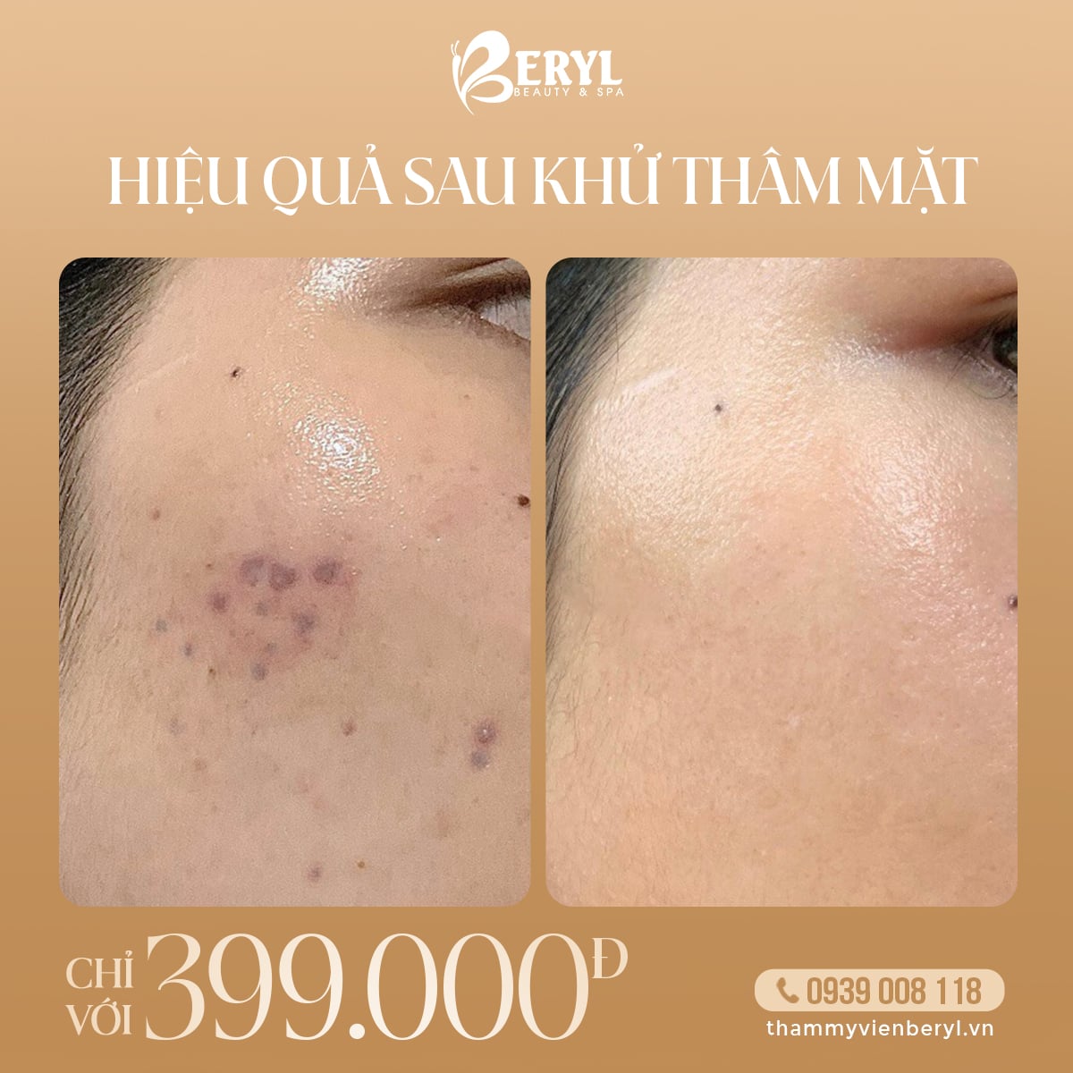 Trị Thâm Mụn 399k