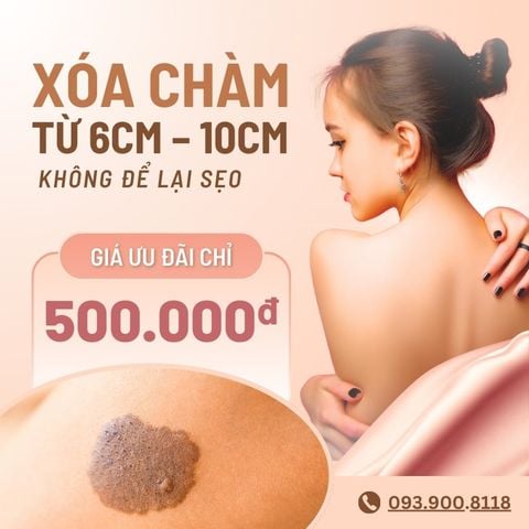 Xóa vết chàm từ 6cm – 10cm