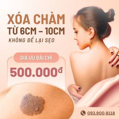 Xóa vết chàm từ 6cm – 10cm