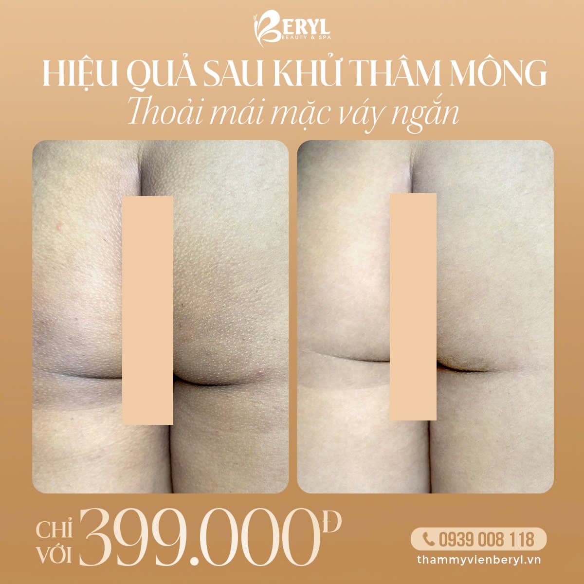 Trị Thâm Mông 399k