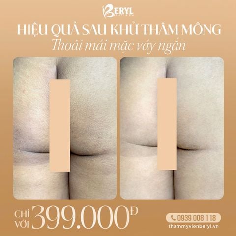 Trị Thâm Mông 399k