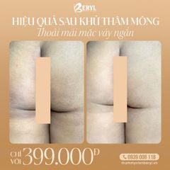 Trị Thâm Mông 399k