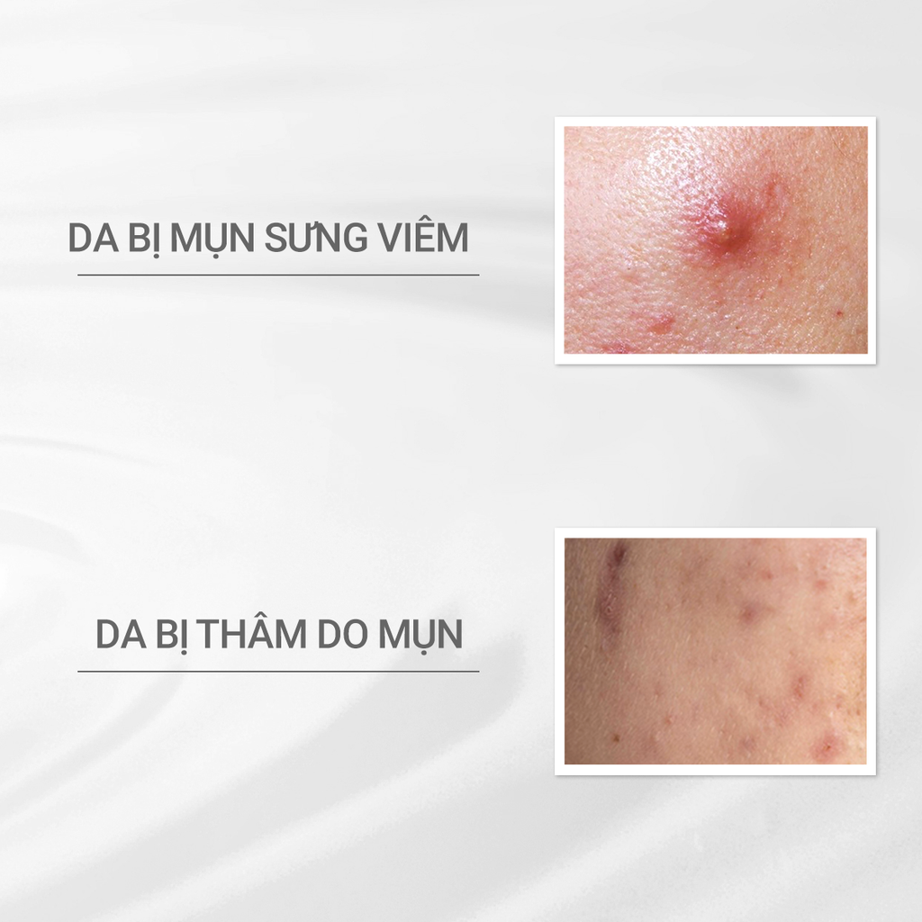  E361: DEAL 7: (01.10 - 04.10) ESSENCE GIẢM MỤN VÀ LÀM MỜ VẾT THÂM D PROGRAM ACNE CARE SPOT ESSENCE 15G 