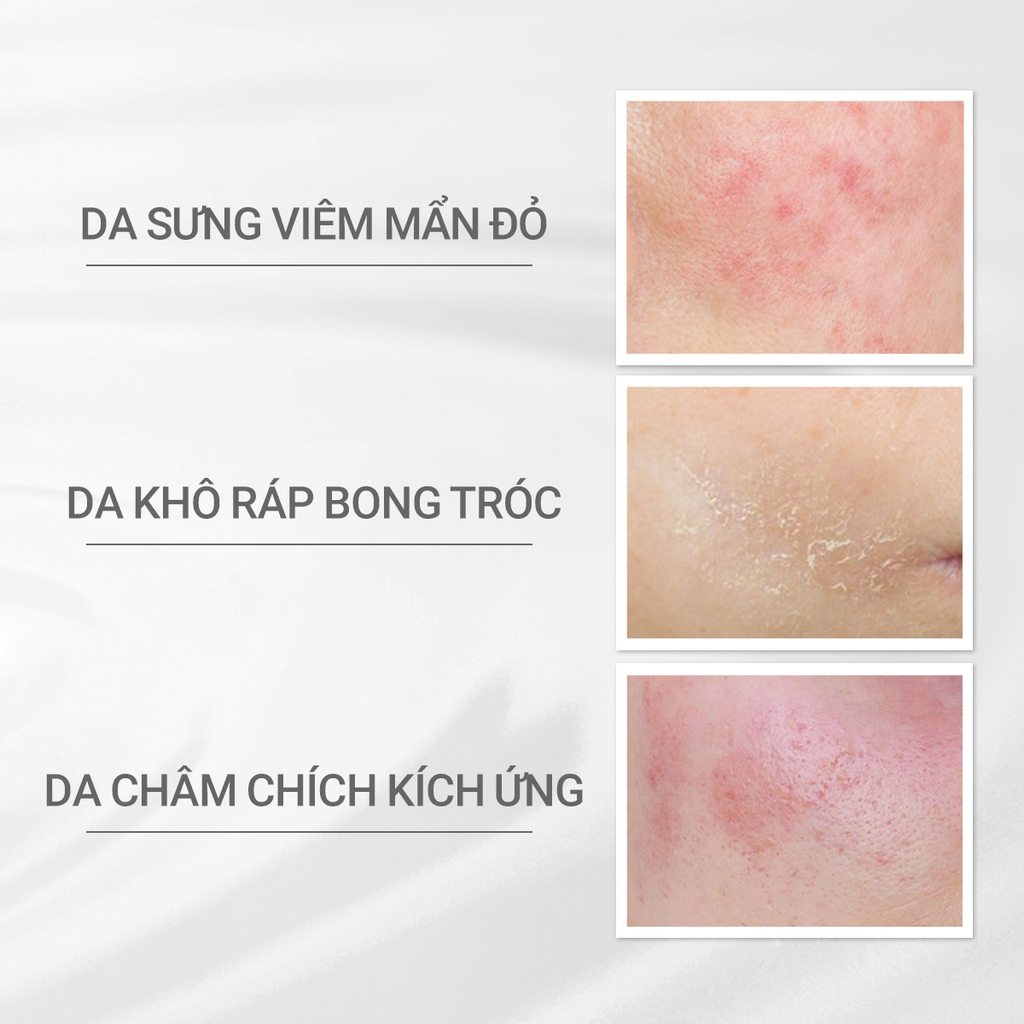  A33: DEAL 17: COMBO ESSENCE GIẢM MỤN VÀ LÀM MỜ VẾT THÂM D PROGRAM ACNE CARE SPOT ESSENCE 15G VÀ KEM DƯỠNG PHỤC HỒI DA MICROBIOME SKIN REPAIR CREAM 45G 