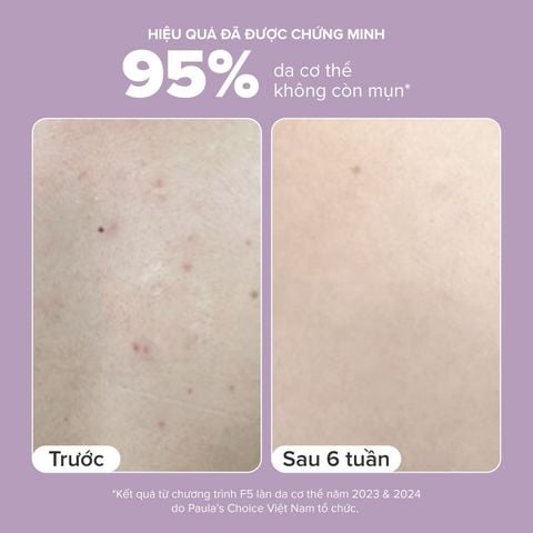  DEAL 7: [PHIÊN BẢN MỚI] KEM DƯỠNG THỂ HỖ TRỢ GIẢM MỤN VÀ LÀM MỊN DA 2% BHA 210ML 