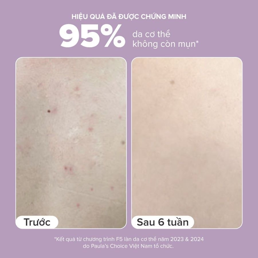  DEAL 7: [PHIÊN BẢN MỚI] KEM DƯỠNG THỂ HỖ TRỢ GIẢM MỤN VÀ LÀM MỊN DA 2% BHA 210ML 