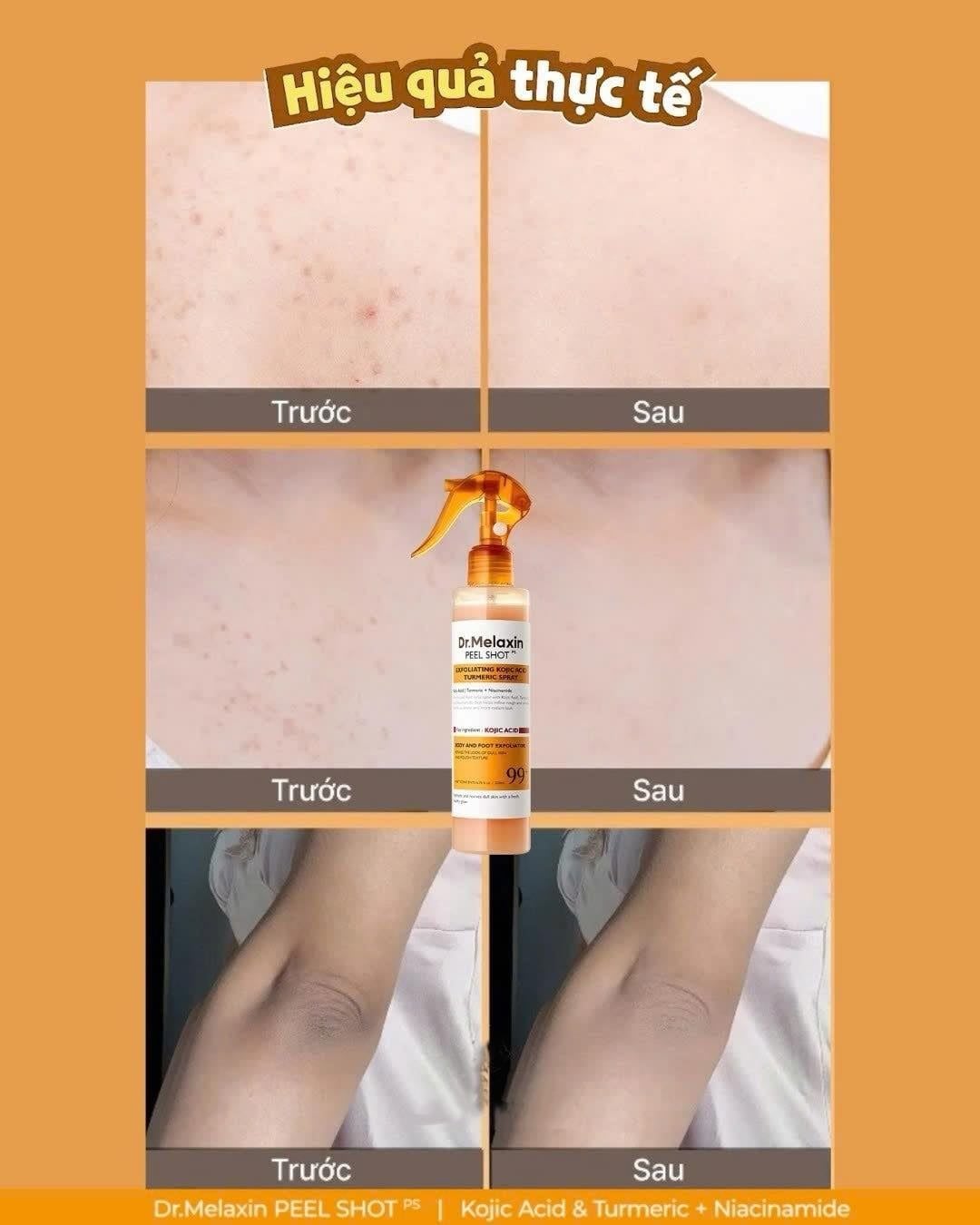  Dung Dịch Xịt Tẩy Tế Bào Chết Cơ Thể Dr.Melaxin Peel Shot Exfoliating Kojic Acid Turmeric Spray 200ml 