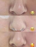  Tinh Chất Ủ Mụn Đầu Đen Ilso Sebum Super Melting Serum Softener 150ml 