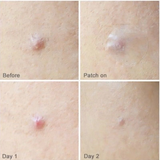  (Xanh Dương) Miếng Dán Mụn Care Plus Scar Cover Spot Patch (102 Miếng) 