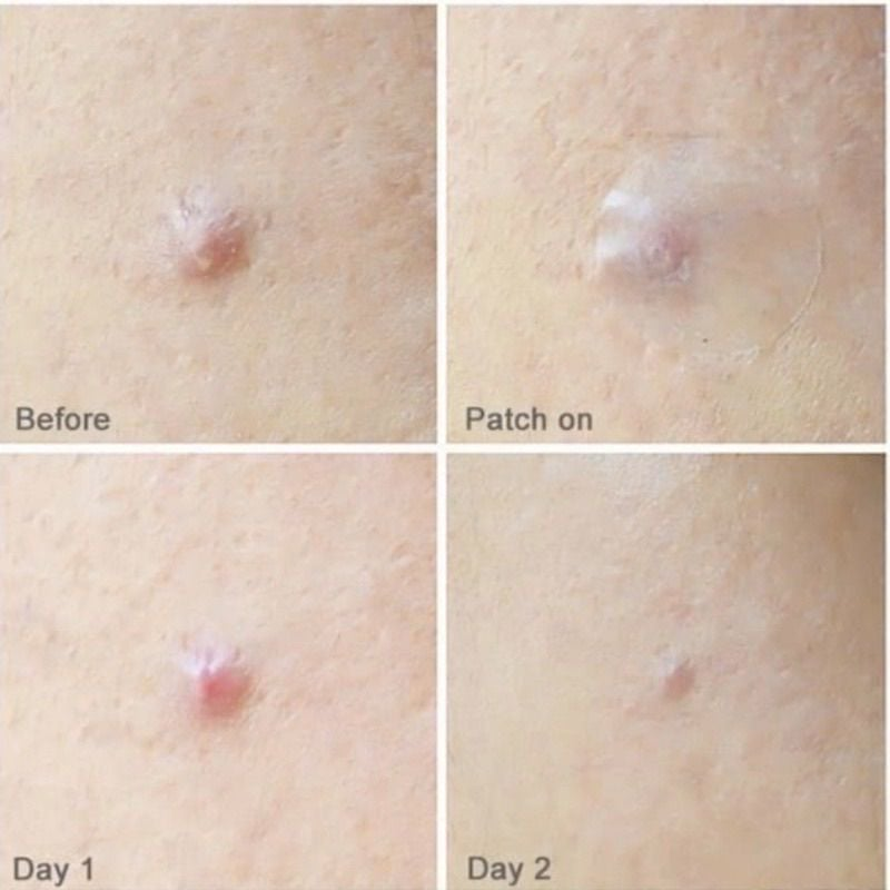  (Xanh Dương) Miếng Dán Mụn Care Plus Scar Cover Spot Patch (102 Miếng) 