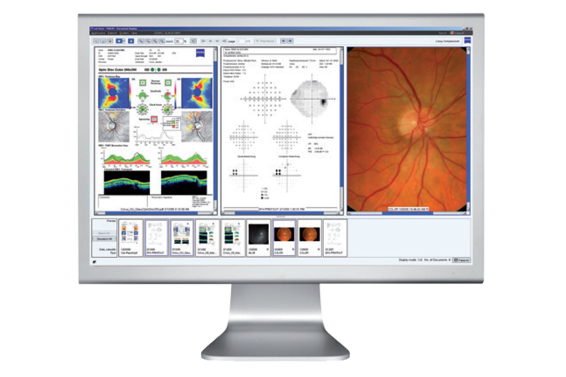  Zeiss glaucoma workflow - Glaucoma workpalce 