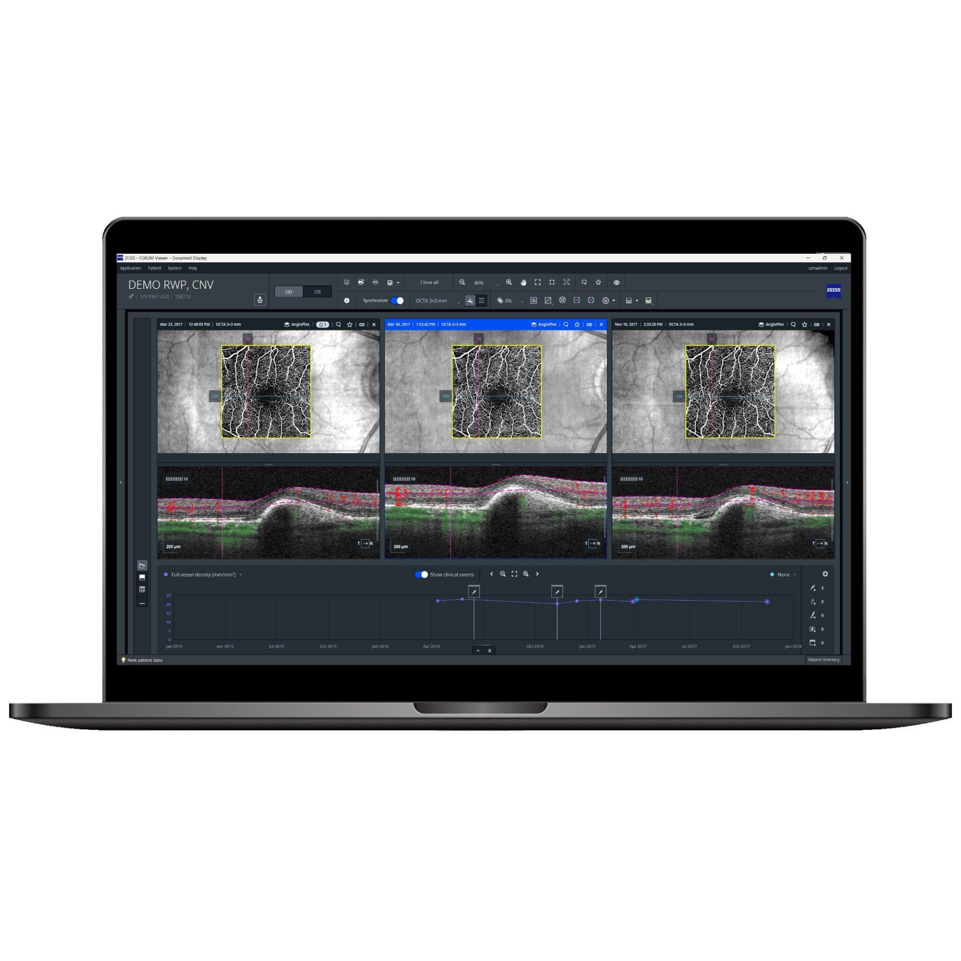  Zeiss retina workflow- Retina workplace 