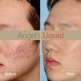  Siêu Tinh Chất Xoá Thâm Đỏ Mờ Sạm Nám Angel'S Liquid Tranexamic Mela Ampoule 30ml 