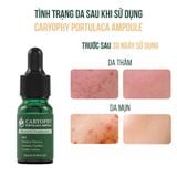 Tinh Chất Giảm Mụn Caryophy Portulaca Ampoule 30ml. 