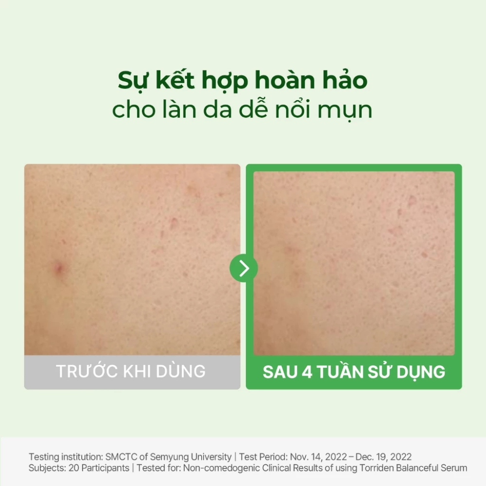 Tinh Chất Cấp Ẩm Và Hỗ Trợ Làm Dịu Cho Da Mụn Torriden Balanceful Centella Asiatica Extract Serum 50ml